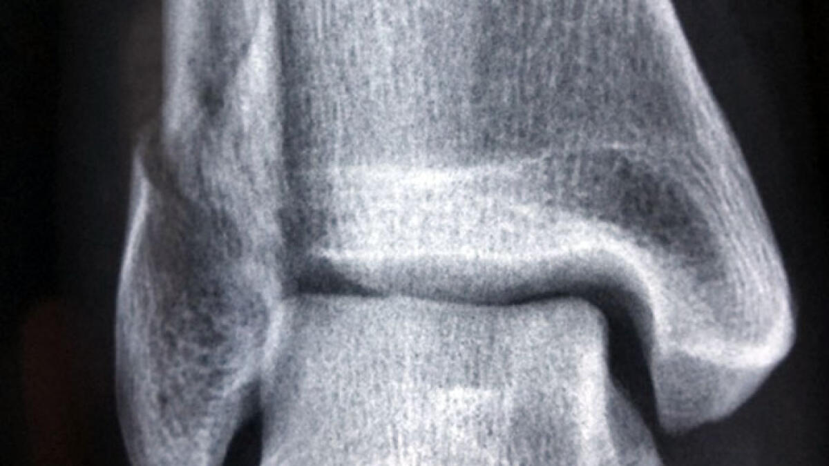 Si facevano fratturare braccia e gambe per truffare le assicurazioni - 