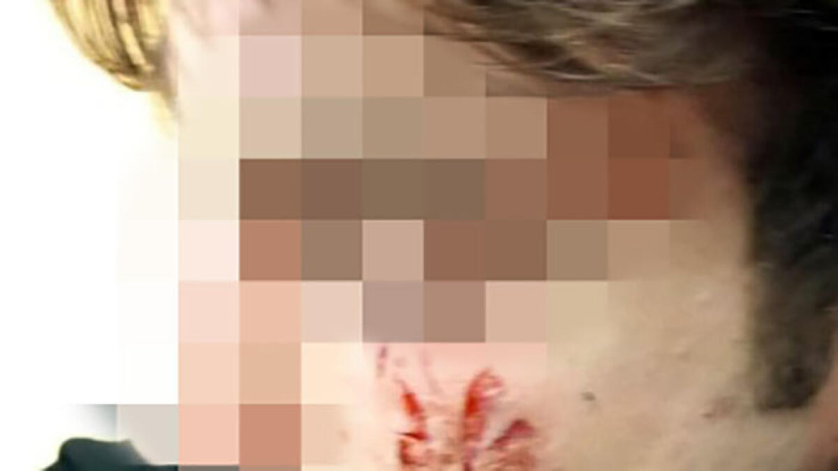 Un 16enne massacrato nella movida: punti al volto e denti rotti - 