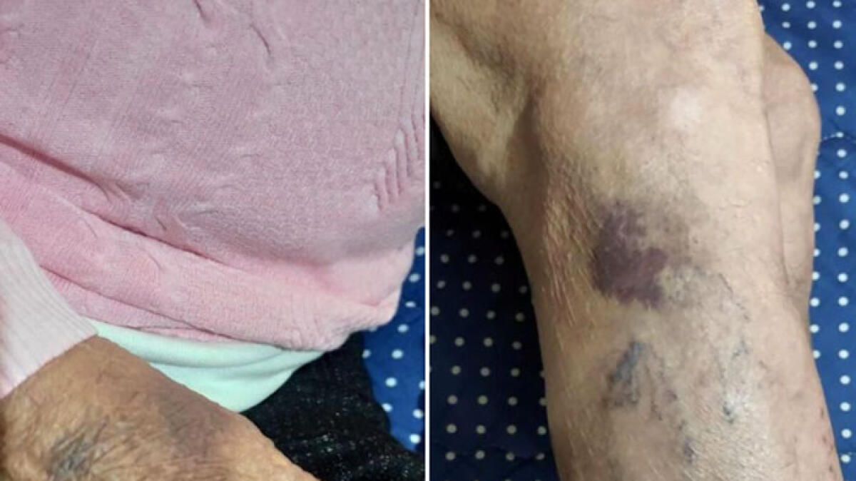 A Marigliano anziana picchiata a bastonata dalla badante - 