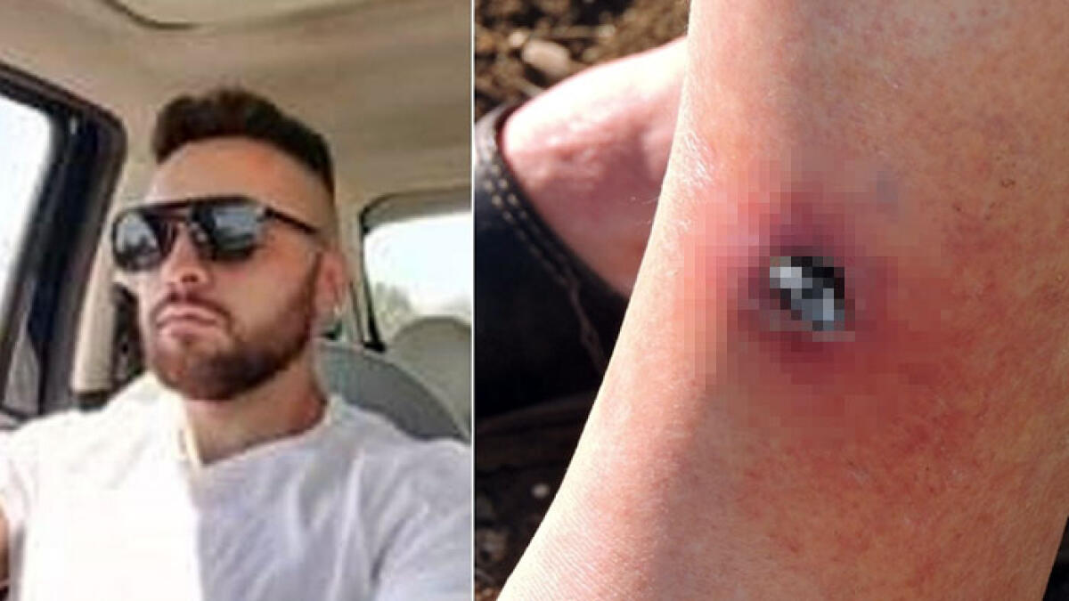 Morso dal ragno violino, Giuseppe muore a 23 anni - 