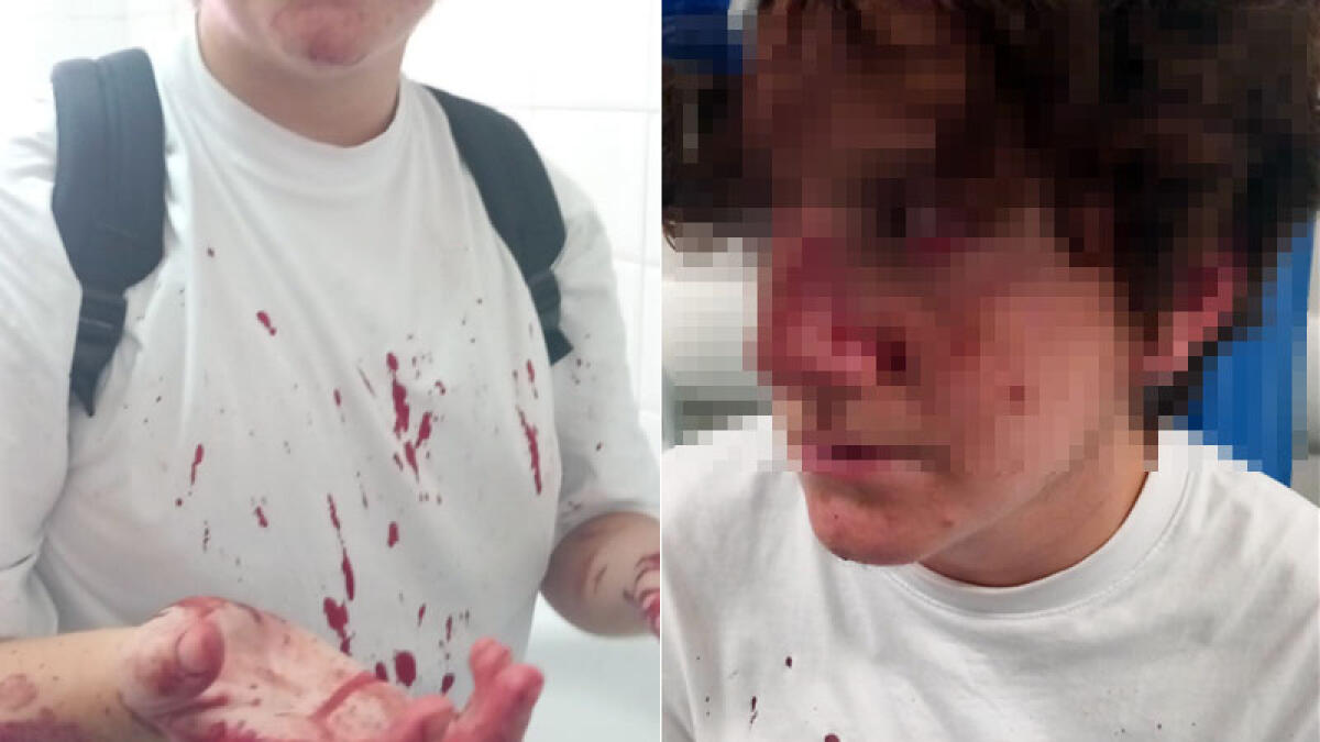 Bruno, 16 anni, sfregiato al volto da due maggiorenni - 