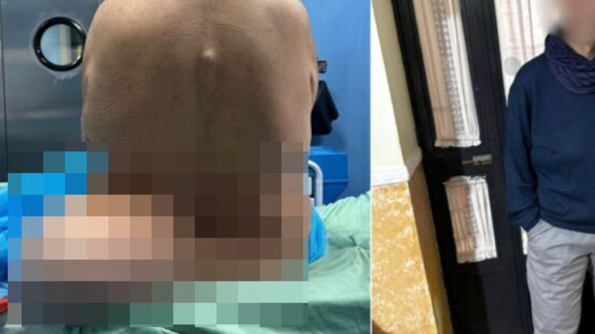 Stomaco nella coscia e nel gluteo dopo un incidente: operato a 13 anni di distanza - 