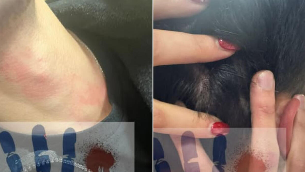 Operatore Oss prende a pugni l'infermiere in ospedale - 