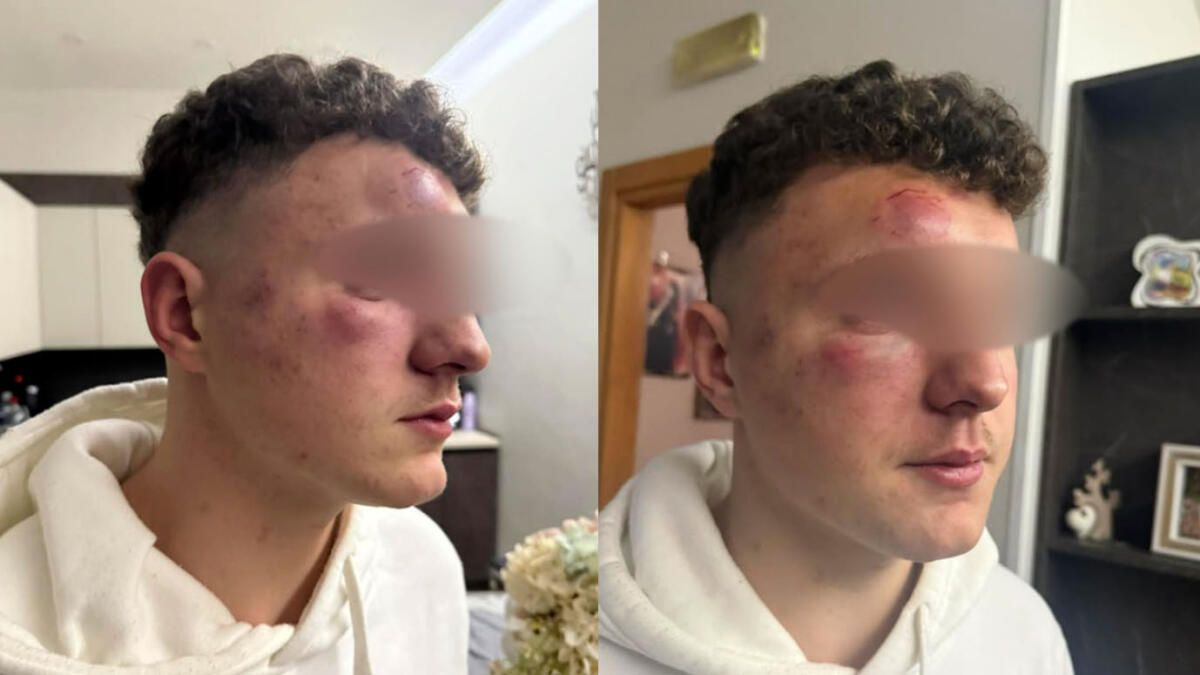 Ha solo 14 anni, ma due ventenni lo prendono a pugni - 