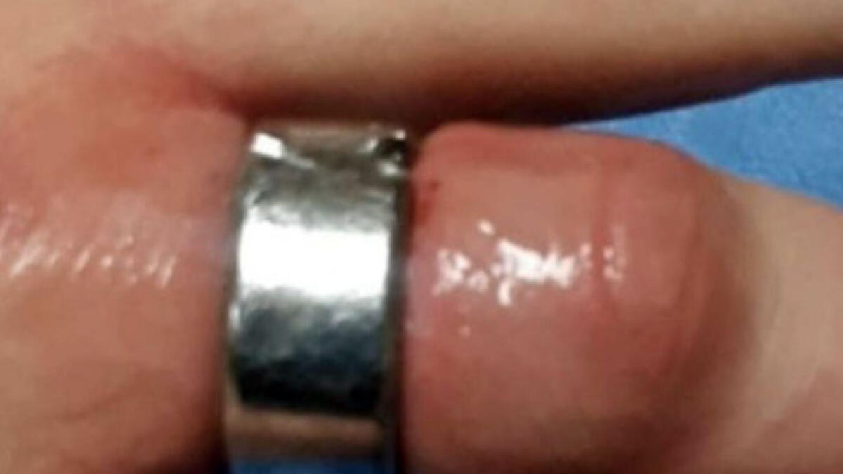 Anello incastrato al dito, 12enne salvato dai pompieri - 