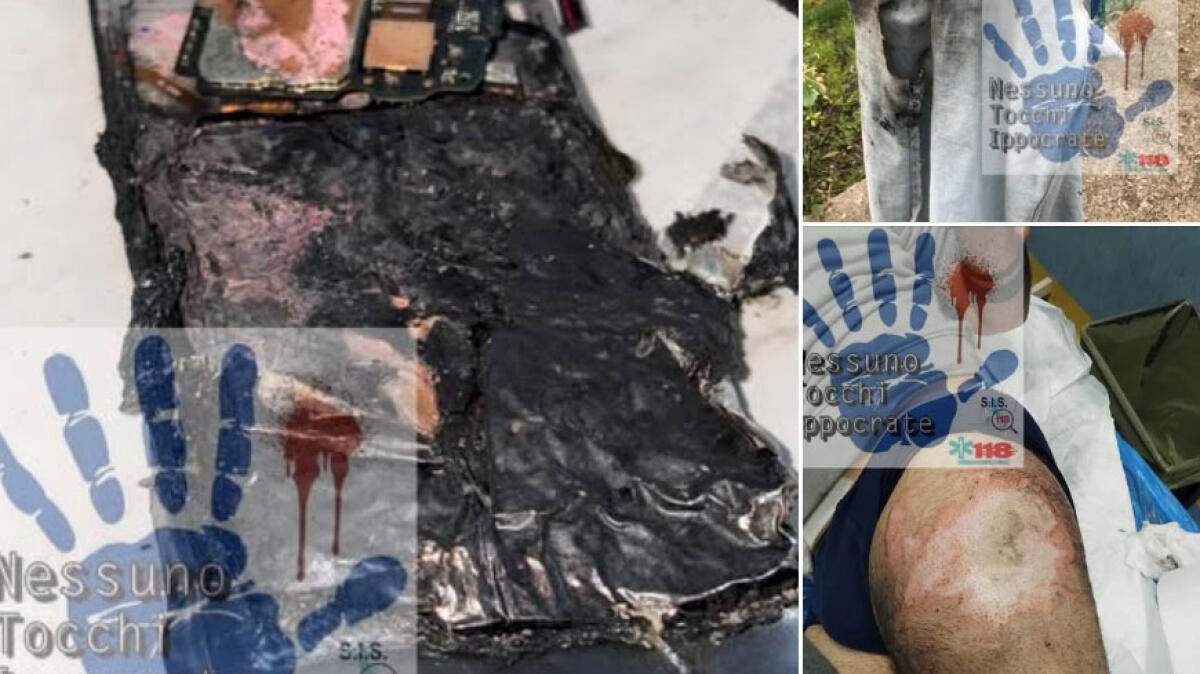 Il cellulare gli esplode in tasca, ferito e ustionato - 