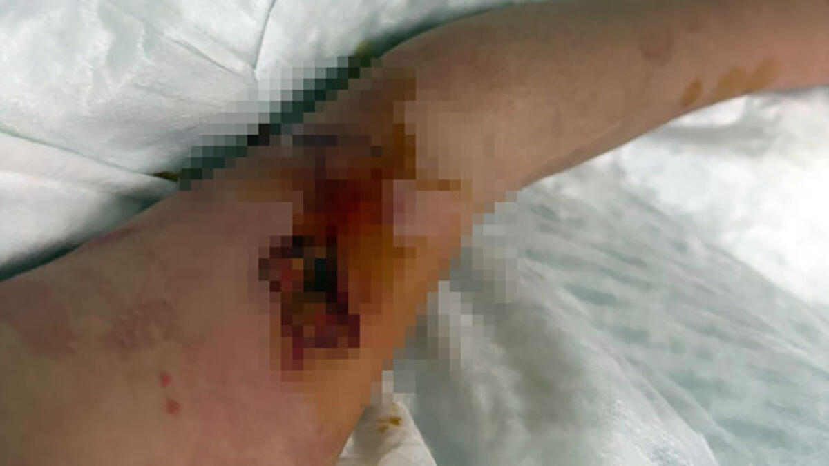 Bimbo di 6 anni azzannato dal pitbull, profonda ferita al braccio - 