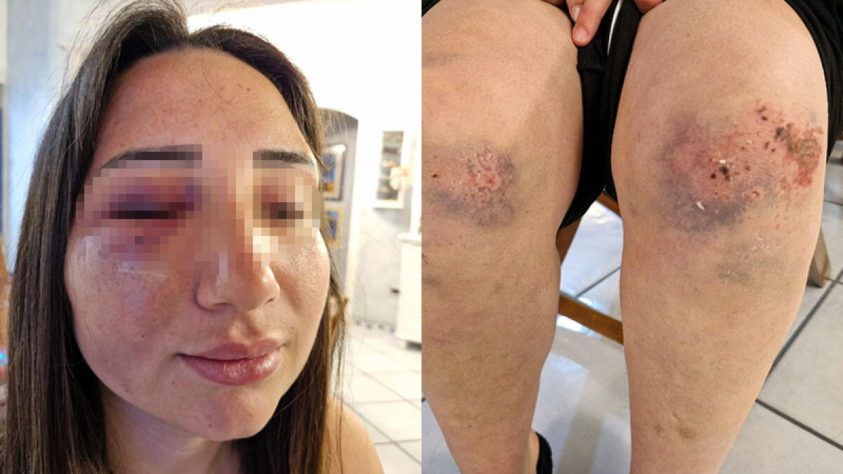 La povera Gaia quasi uccisa dal compagno, caccia ai complici - 