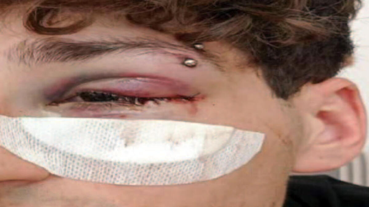 Sporca una scarpa mentre è con gli amici, finisce pestato - 