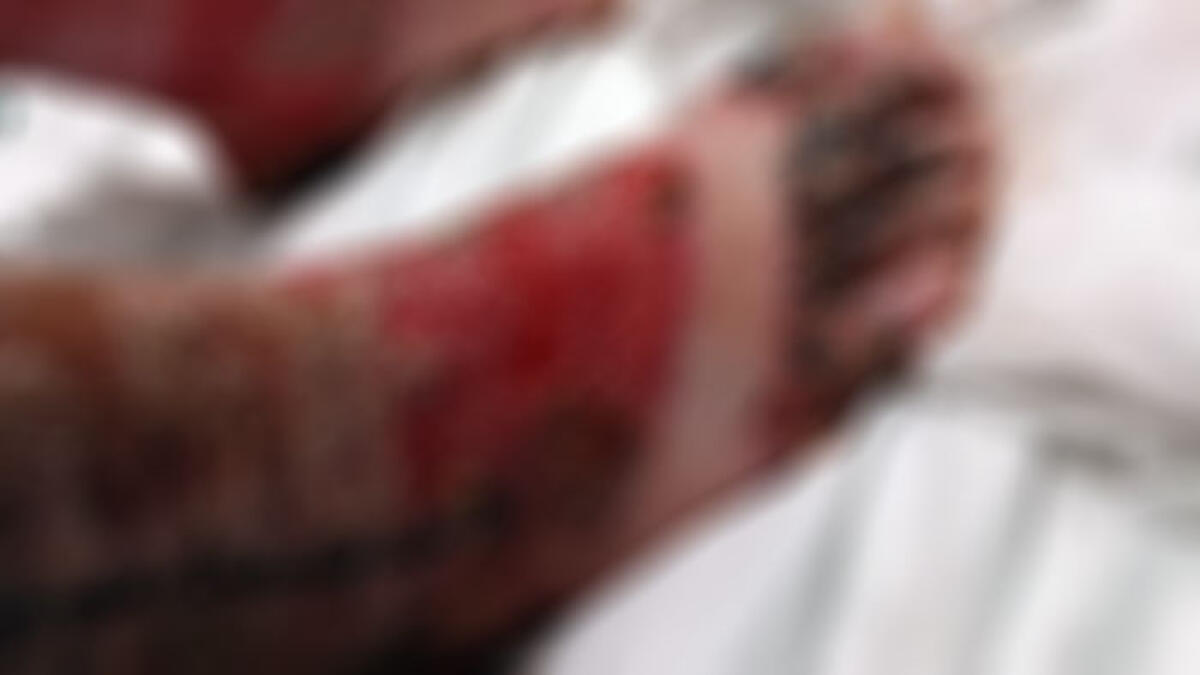 Auto in fiamme sul marciapiede a Pollena, bambino gravemente ustionato - 