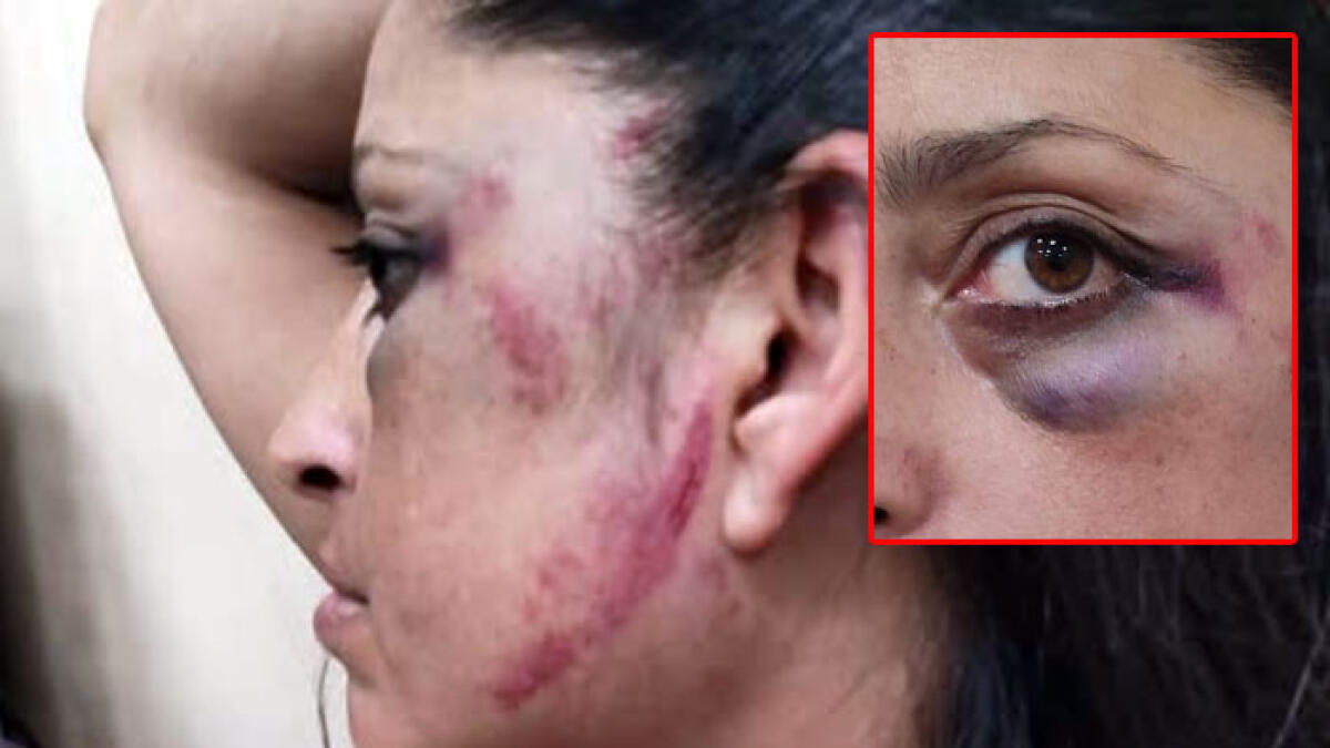 Ridotta in una maschera di lividi dal fidanzato della figlia - 