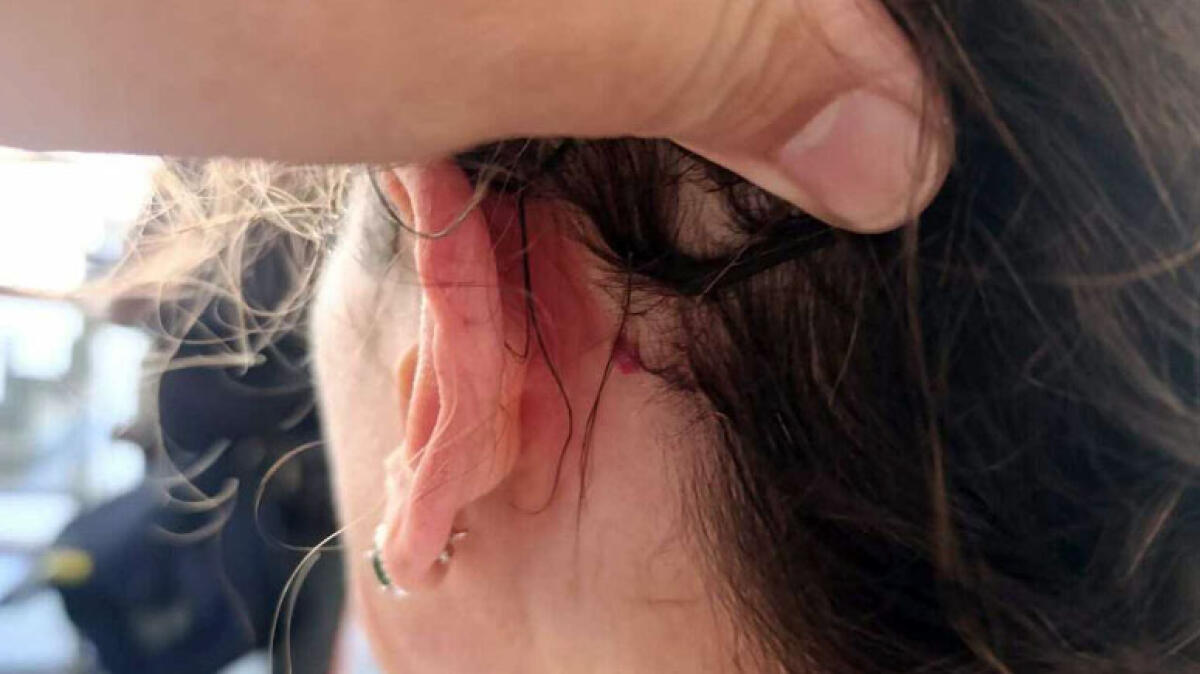 Donna ferita alla testa da un colpo di pistola ad aria compressa - 