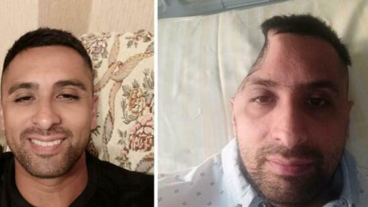 Gli tolgono una parte di cranio dopo l'incidente: "Nessuno mi risarcisce" - 