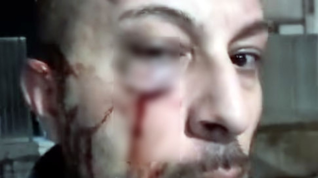 Vigilante ferito al volto alla stazione di Poggiomarino - GUARDA IL VIDEO - 