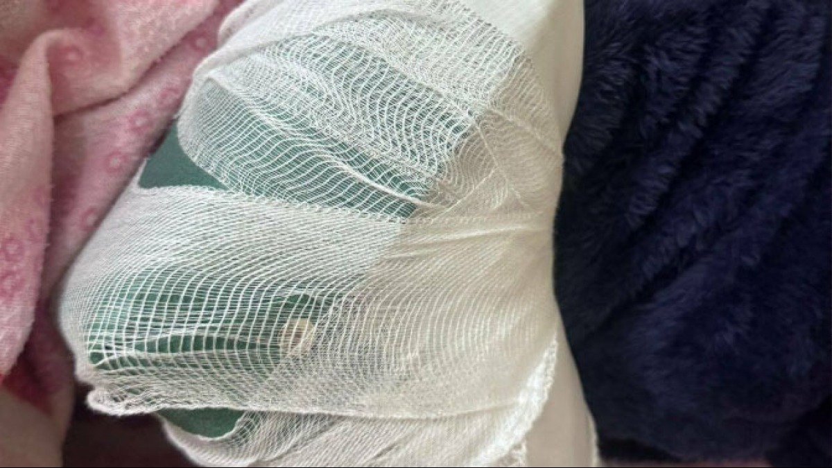 Ragazza di 15 anni picchiata da coetanee nel Nolano: ha un braccio fratturato - 