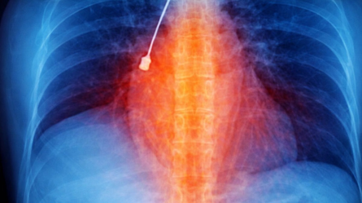 Radiografia al torace, medici scoprono cacciavite nei bronchi di una giovane - 