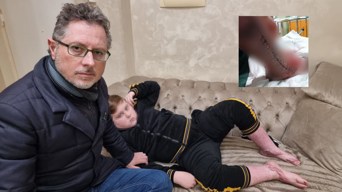 Bimbo ustionato dallo scoppio di un'auto a Sant'Anastasia: "Gambe rovinate" - 