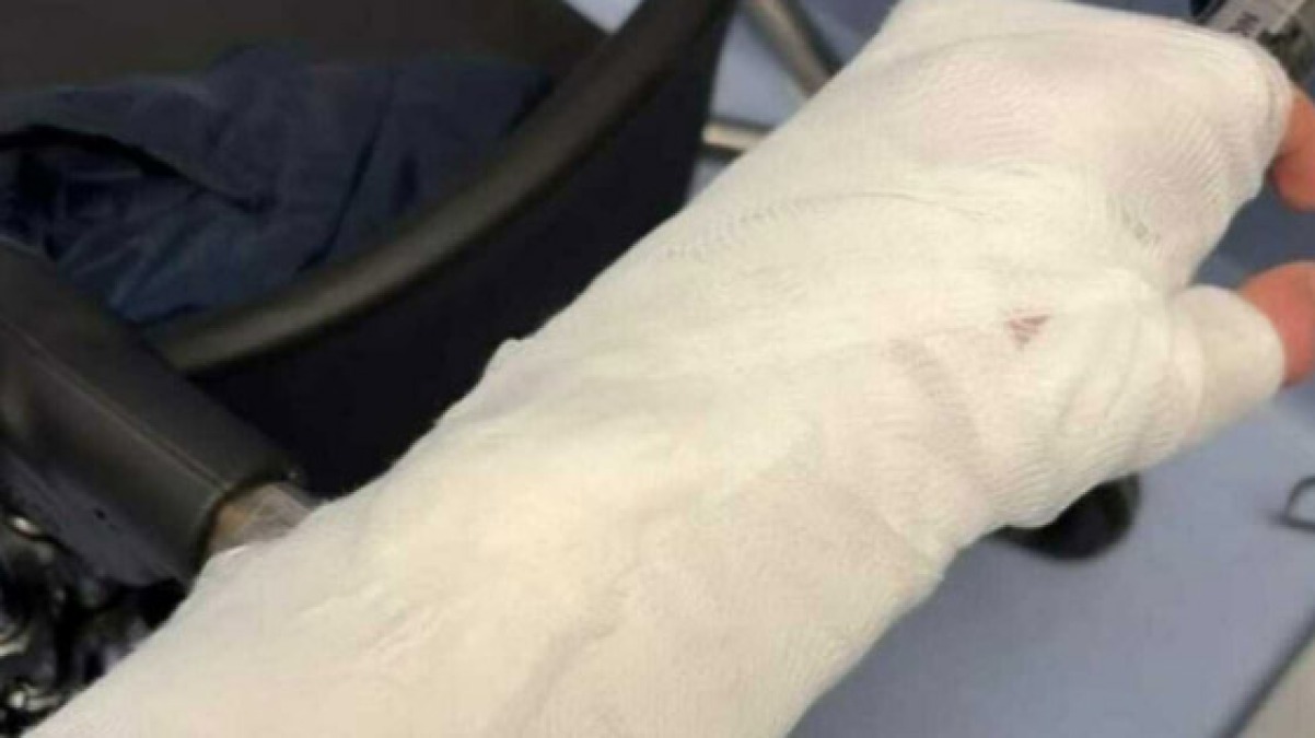 Rissa in campo, calciatore ha un braccio rotto - 