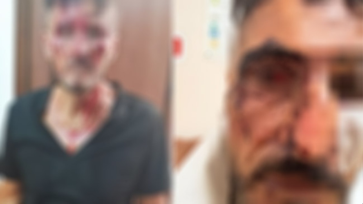 Aggredito con una mazza da baseball e ridotto malissimo - 